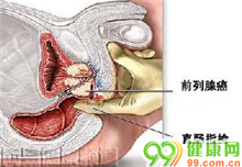 前列腺癌